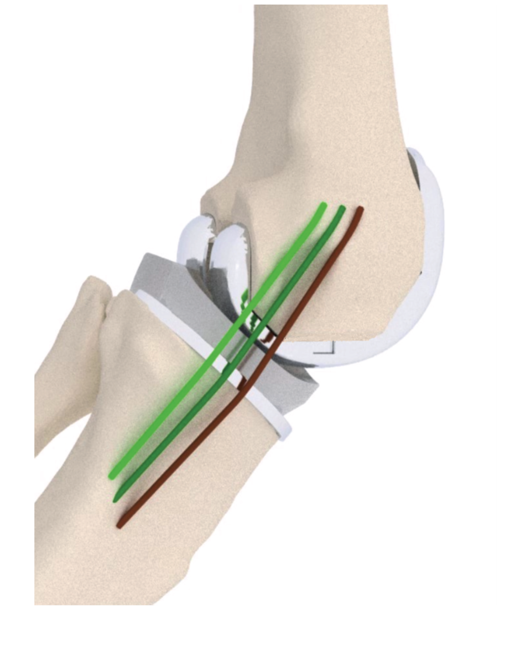 Enlarged view: Ligament Strain