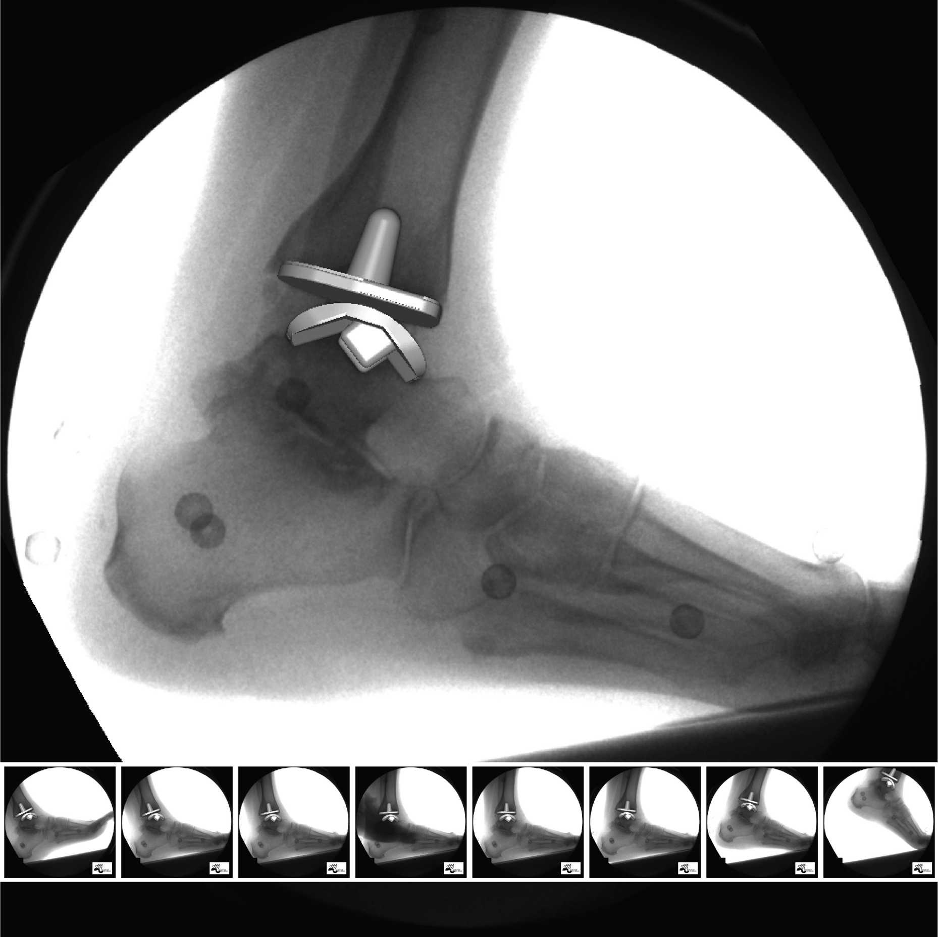 Enlarged view: Total ankle arthroplasty subject during the stance phase of walking uphill 